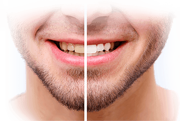 Недорогое отбеливание зубов