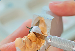 восстановление зуба керамической вкладкой
