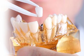 Протезирование передних зубов 3
